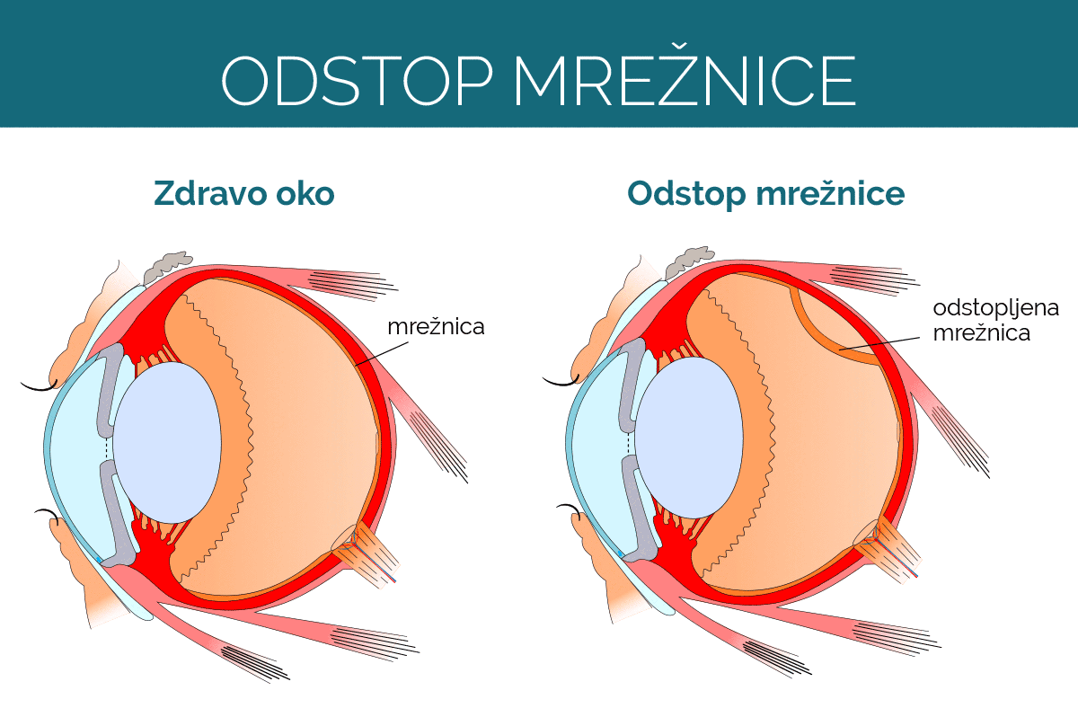 Shema: prikaz odstopa mrežnice, ki lahko povzroči bliskanje pred očmi