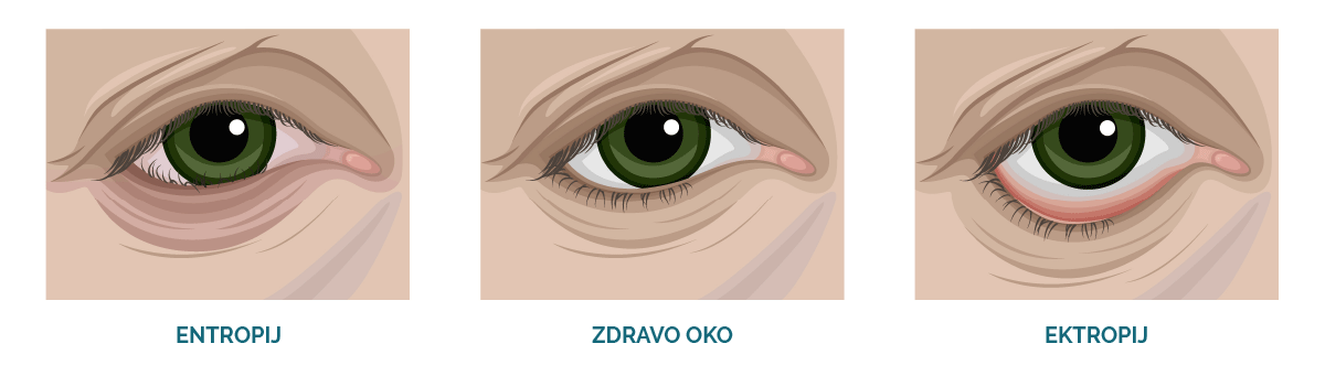 primerjava: entropij, ektropij, trihiaza