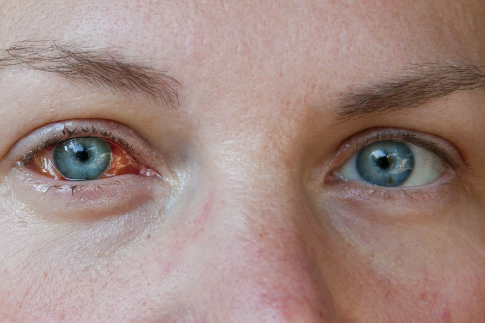 keratitis ali vnetje roženice