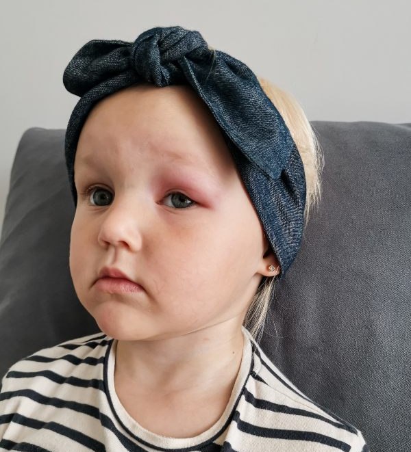 otečene veke zaradi pika komarja pri majhni deklici
