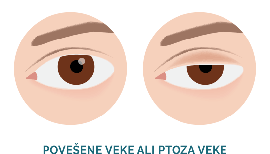 risba: povešene veke ali ptoza veke