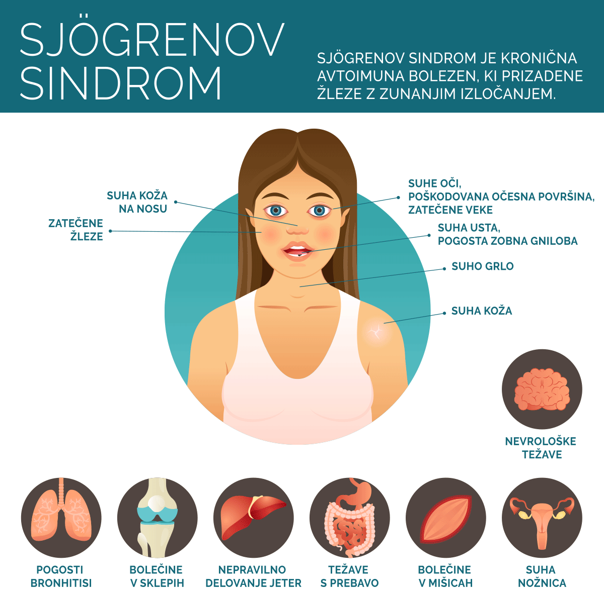 infrografika: sjogrenov sindrom in simptomi