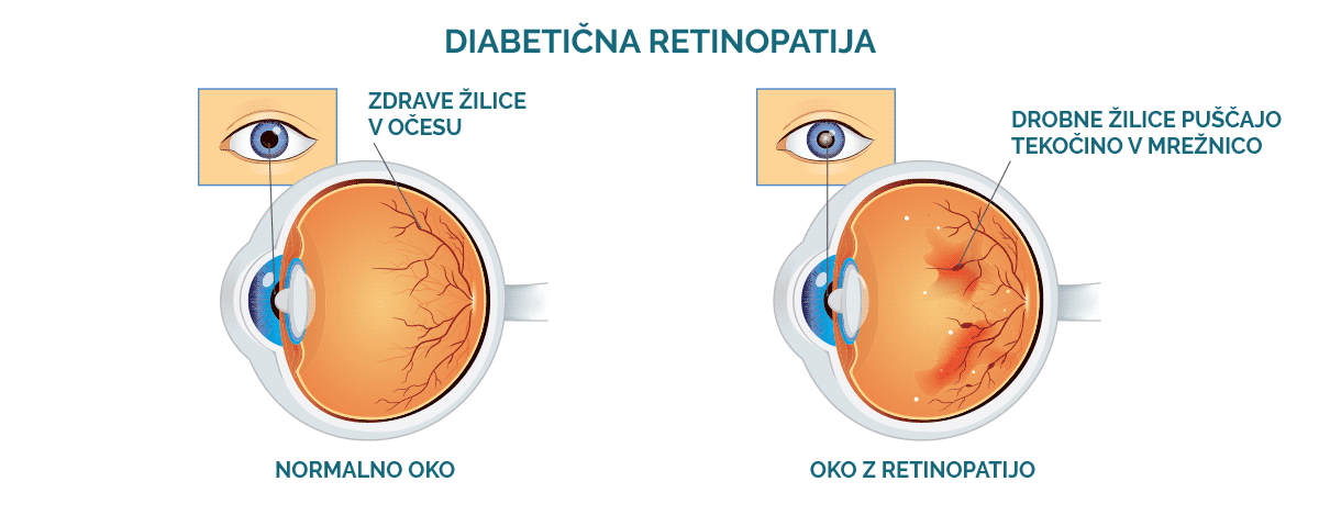 diabetična retinopatija: slikovni prikaz